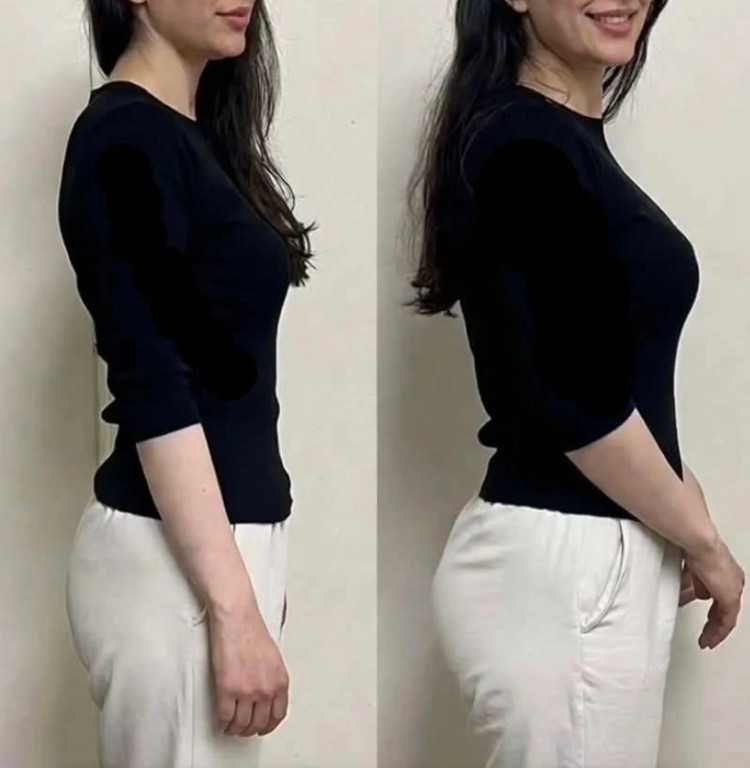 افزایش حجم باسن